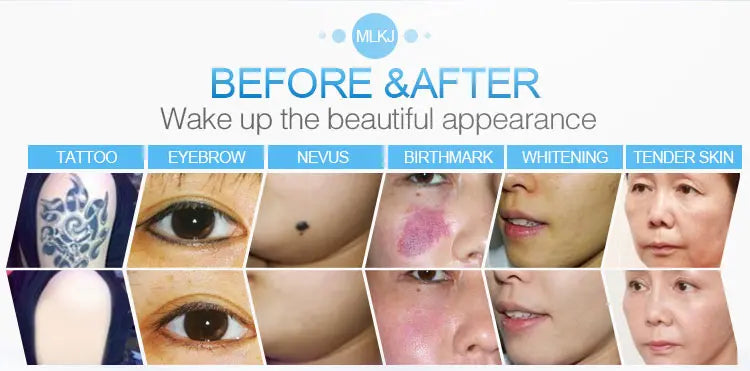 Emszero IPL Skin Rejuvenation And Hair Removal System