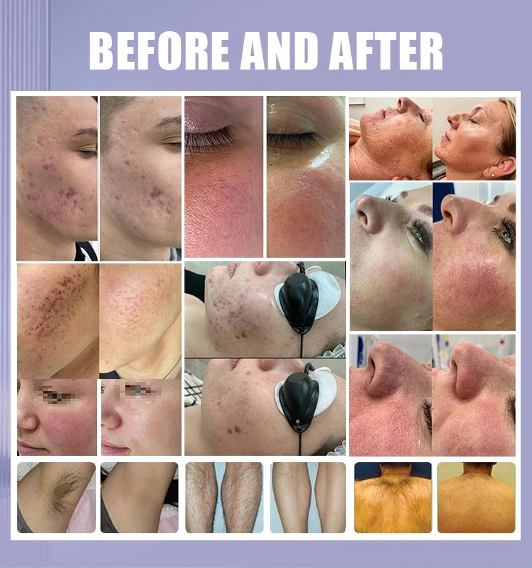 Emszero IPL Skin Rejuvenation And Hair Removal System